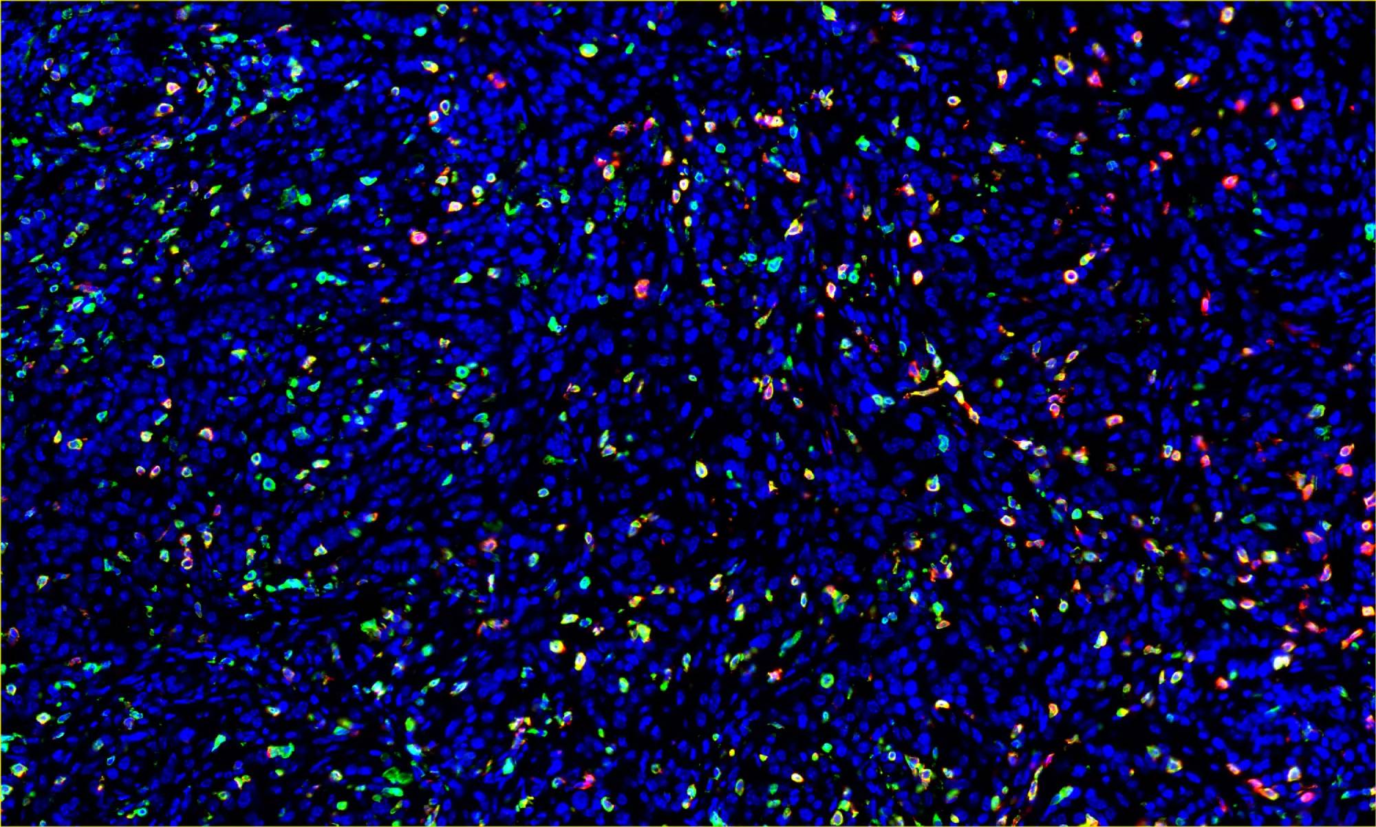 Melanoma Tumor Microenvironment (Green; CD45+ cells, Red; CD8+ cells)